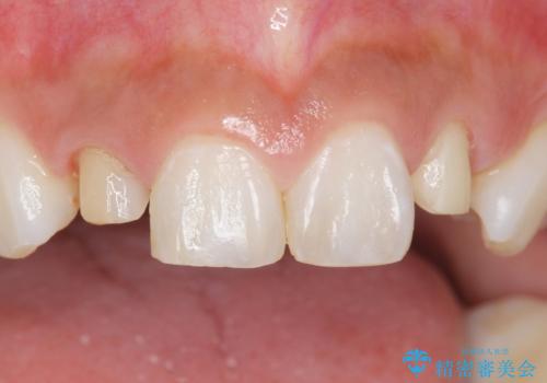 前歯の色と隙間が気になる 早く治したい 矯正は嫌 30代女性の治療中