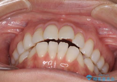 少しだけ飛び出た前歯を整えたい インビザラインによる矯正治療の治療前