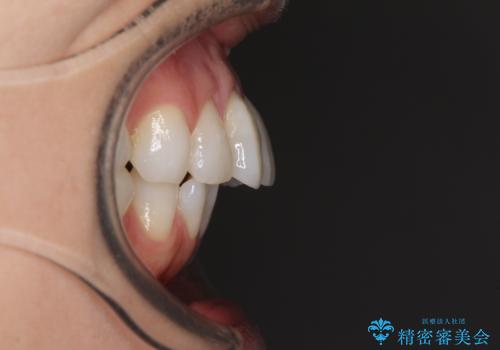 少しだけ飛び出た前歯を整えたい インビザラインによる矯正治療の治療前