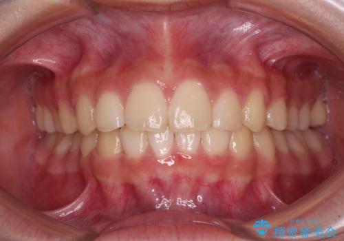 下の前歯が隠れてしまうほど深い咬み合わせ 高校生のインビザライン矯正治療の治療後