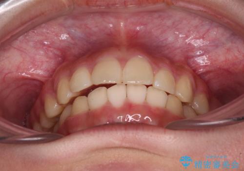 下の前歯が隠れてしまうほど深い咬み合わせ 高校生のインビザライン矯正治療の治療後