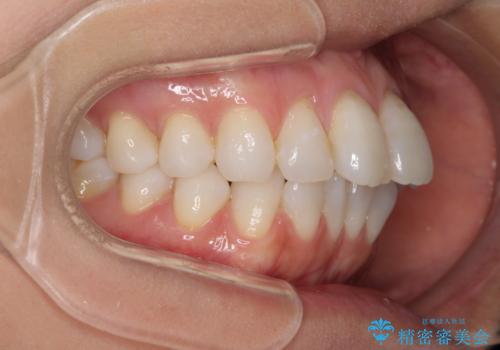 少しだけ飛び出た前歯を整えたい インビザラインによる矯正治療の治療前