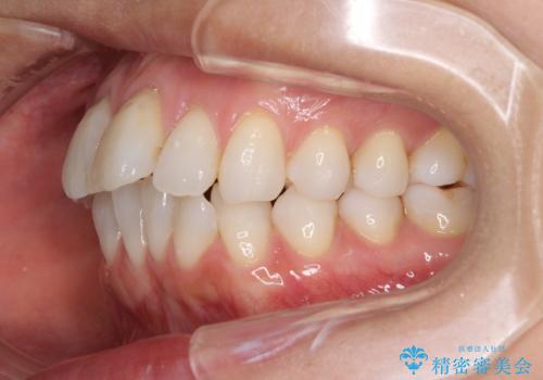 少しだけ飛び出た前歯を整えたい インビザラインによる矯正治療の治療前