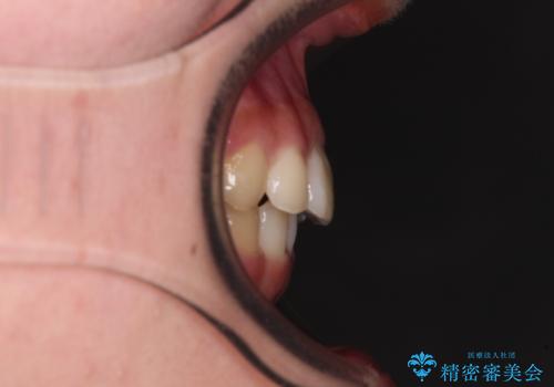 下の前歯が隠れてしまうほど深い咬み合わせ 高校生のインビザライン矯正治療の治療後