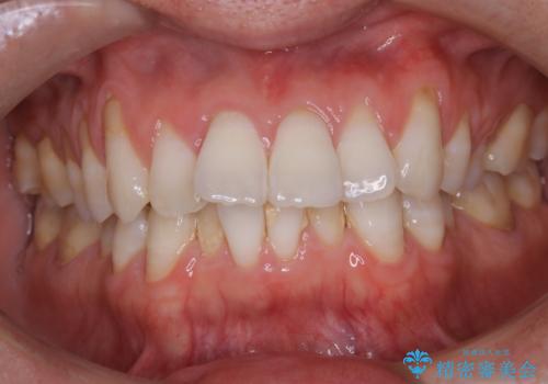 30代男性 PMTCで歯石取りの治療前