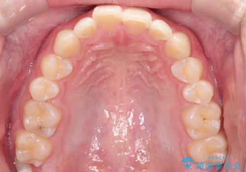 出っ歯が気になる インビザラインによる出っ歯の目立たない矯正の治療前