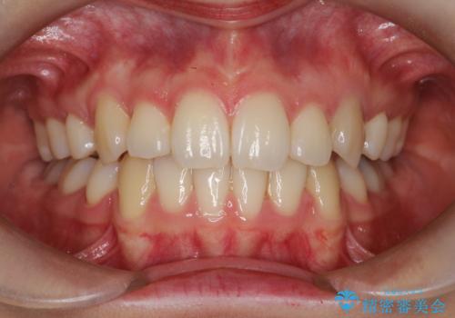 重度のガタガタ ハーフリンガルによる目立たない抜歯矯正の治療後