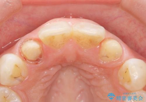 前歯の色と隙間が気になる 早く治したい 矯正は嫌 30代女性の治療中