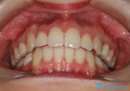 重度のガタガタ ハーフリンガルによる目立たない抜歯矯正の治療後
