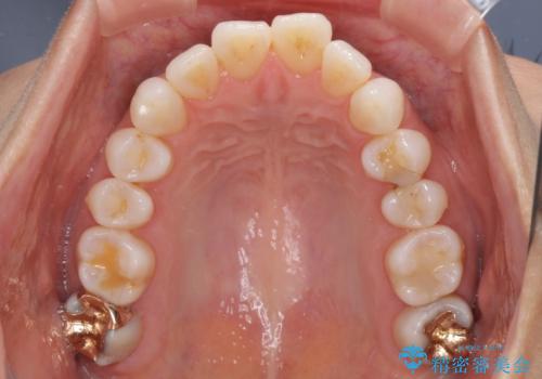 少しだけ飛び出た前歯を整えたい インビザラインによる矯正治療の治療前