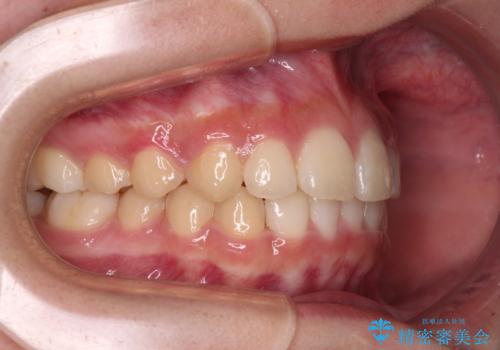 下の前歯が隠れてしまうほど深い咬み合わせ 高校生のインビザライン矯正治療の治療後