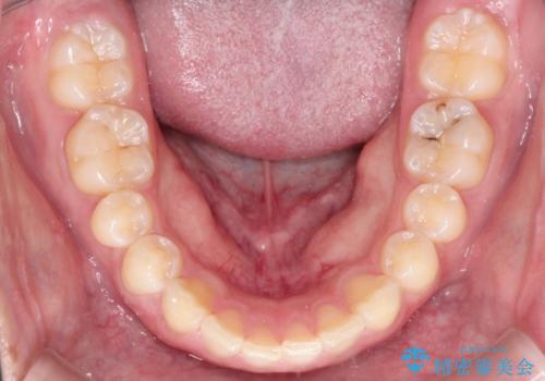出っ歯が気になる インビザラインによる出っ歯の目立たない矯正の治療前