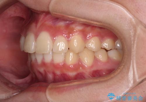 下の前歯が隠れてしまうほど深い咬み合わせ　高校生のインビザライン矯正治療の治療後