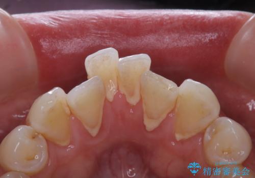 30代男性 PMTCで歯石取りの治療前