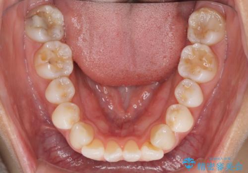 少しだけ飛び出た前歯を整えたい インビザラインによる矯正治療の治療前