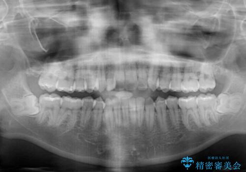 抜けてしまうと言われた前歯 インビザラインによる矯正治療の治療前