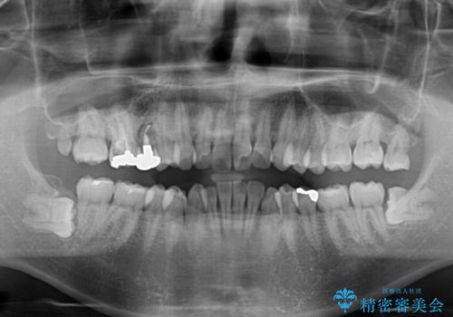 インビザラインによる矯正治療と、折れてしまった歯のインプラント補綴治療の治療前