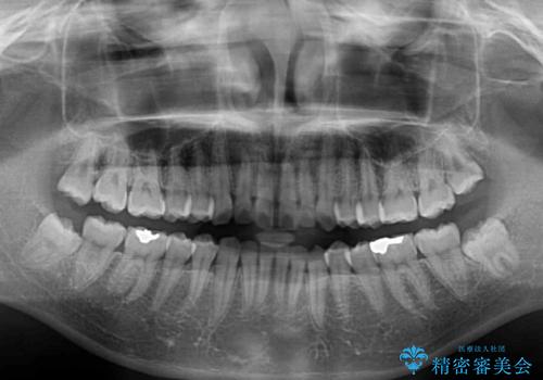 前歯のデコボコと突出感 インビザラインによる矯正治療の治療前