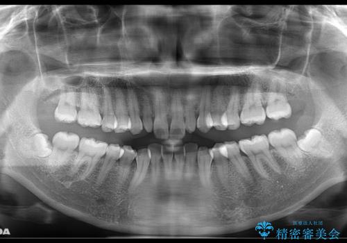 矮小歯を綺麗な歯に。矯正とセラミックの総合治療の治療前