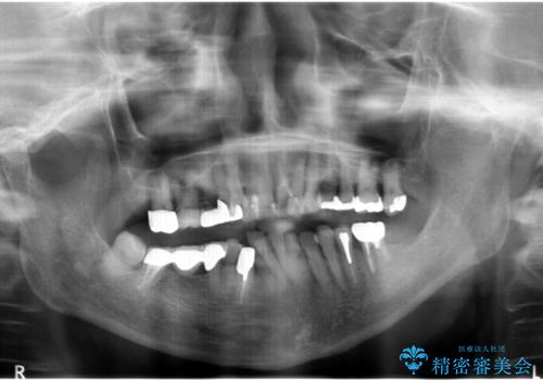 親知らずの移植 4年半経過症例 70代女性の治療前