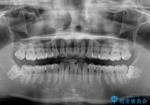 矯正治療の後戻りをインビザライン・ライトで解消の治療前