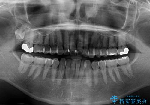 少しだけ飛び出た前歯を整えたい インビザラインによる矯正治療の治療前