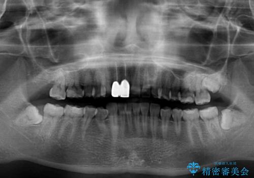 一度諦めた矯正にチャレンジしたい インビザラインとセラミック治療の治療前