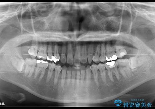歯がないところに歯をつくる:矯正とセラミックの合わせ技で審美的な口元をの治療前