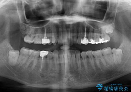 インビザライン単独では困難 補助装置を併用した矯正治療の治療前
