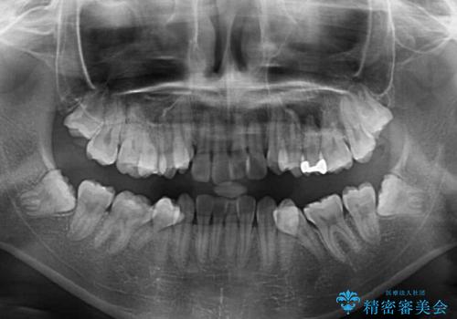 前歯の歯並びを治したい ワイヤー装置での抜歯矯正の治療前