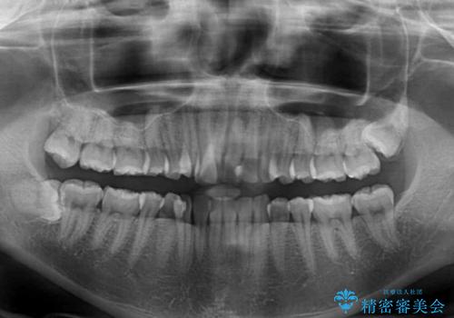 内側にある歯が邪魔 重なった前歯の歯列矯正の治療前