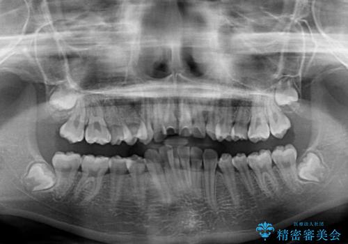 下の前歯が隠れてしまうほど深い咬み合わせ 高校生のインビザライン矯正治療の治療前