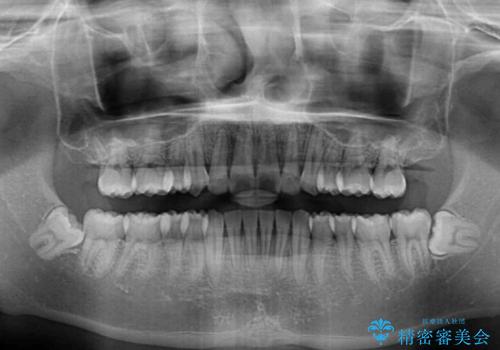 矯正治療の後戻りをインビザライン・ライトで解消の治療後