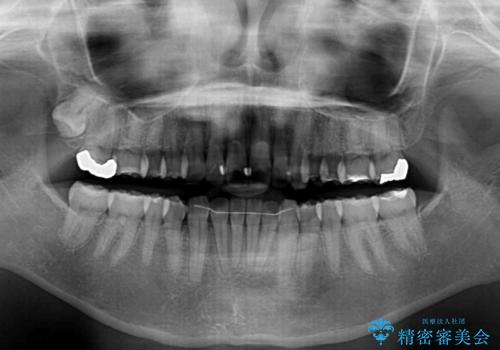 少しだけ飛び出た前歯を整えたい インビザラインによる矯正治療の治療後