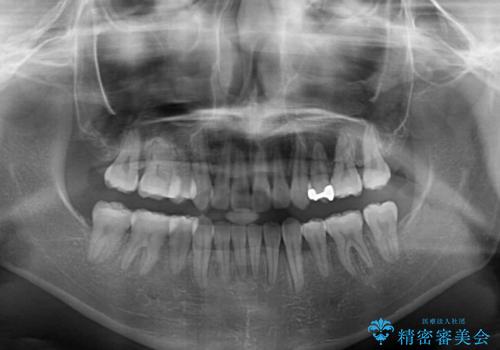 前歯の歯並びを治したい　ワイヤー装置での抜歯矯正の治療後