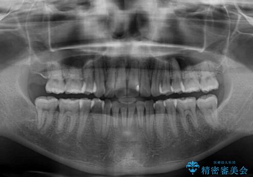 内側にある歯が邪魔 重なった前歯の歯列矯正の治療後