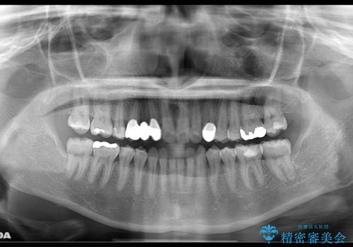 歯がないところに歯をつくる:矯正とセラミックの合わせ技で審美的な口元をの治療後