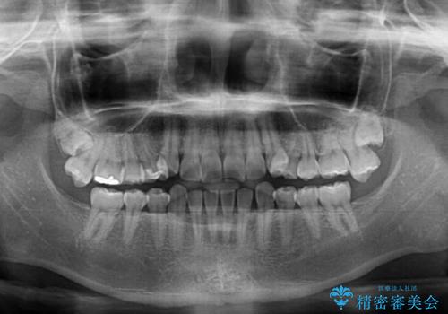 奥歯の欠損を放置 大臼歯を抜歯した矯正治療の治療前