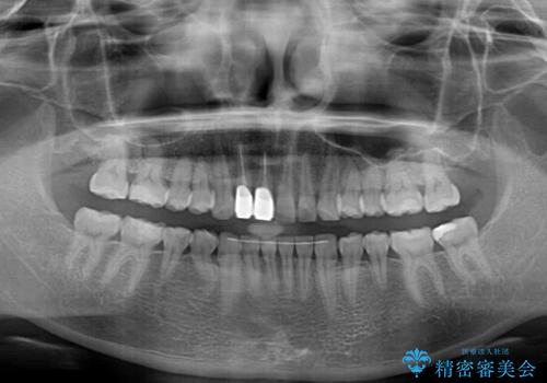 一度諦めた矯正にチャレンジしたい インビザラインとセラミック治療の治療後