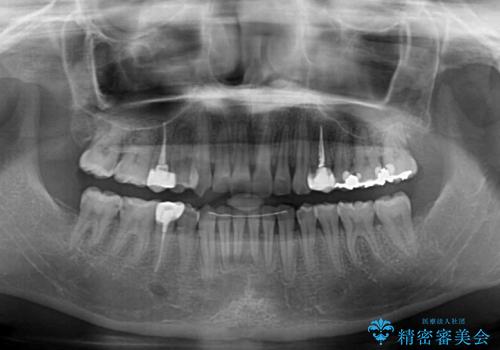 インビザライン単独では困難 補助装置を併用した矯正治療の治療後