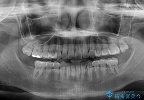 奥歯の欠損を放置 大臼歯を抜歯した矯正治療の治療後