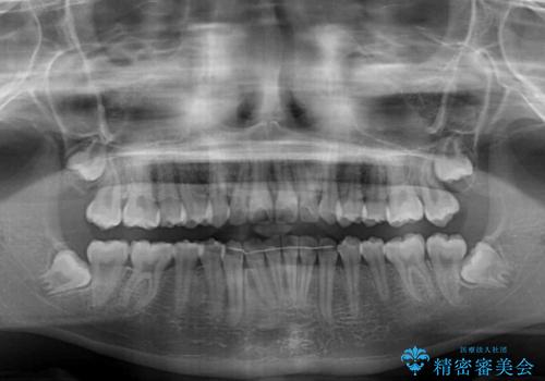 下の前歯が隠れてしまうほど深い咬み合わせ 高校生のインビザライン矯正治療の治療後