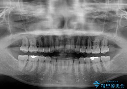 前歯のデコボコと突出感 インビザラインによる矯正治療の治療後