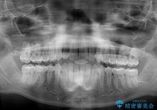 抜けてしまうと言われた前歯 インビザラインによる矯正治療の治療後