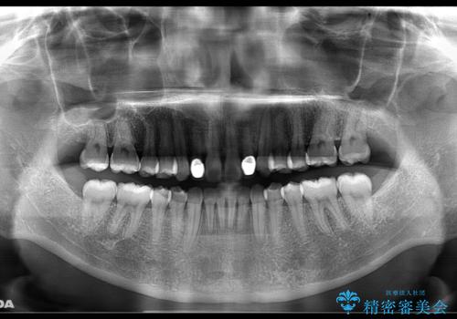 矮小歯を綺麗な歯に。矯正とセラミックの総合治療の治療後