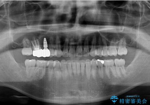 インビザラインによる矯正治療と、折れてしまった歯のインプラント補綴治療の治療後