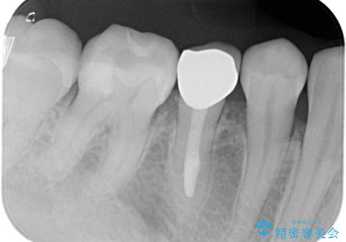 笑った時に見える金属を白くしたいの治療後