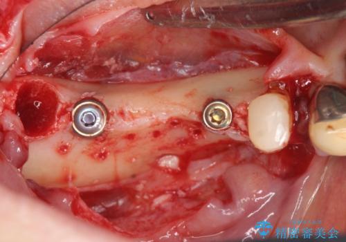 薄い骨幅 骨造成 歯肉移植を併用したインプラント治療の治療前