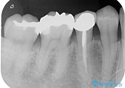 笑った時に見える金属を白くしたいの治療前