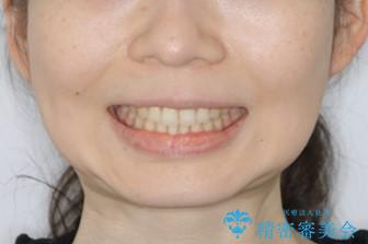 見た目だけじゃない:マウスピースでも短期間で噛み合わせと口元を改善の治療後(顔貌)